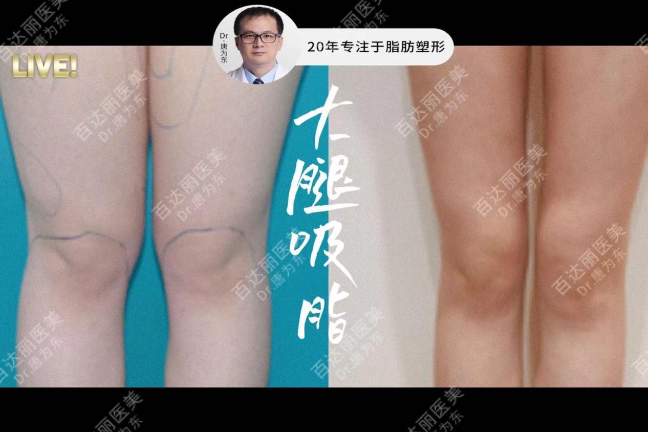 唐为东医生首创低压柔性吸脂安全满足消费者美体需求