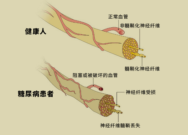 糖尿病血管.jpg