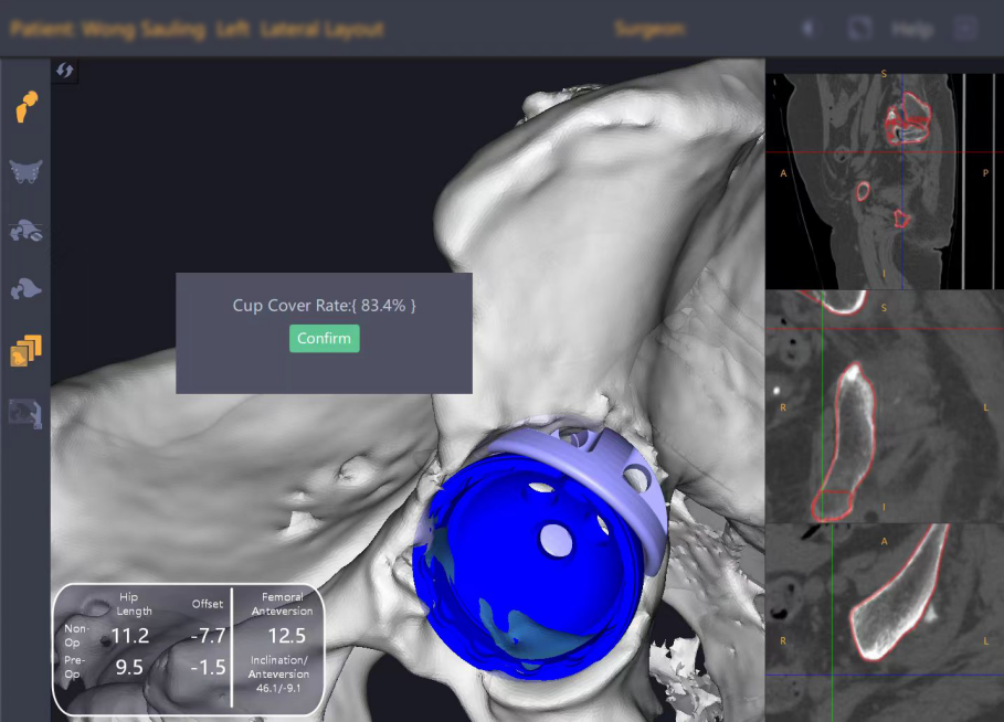 全球首例！港医疗团队借深锟铻®机器人“塔积木” 重建复杂髋关节